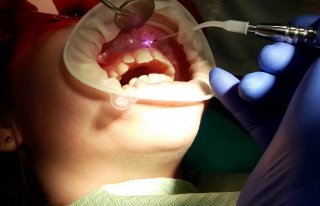 Применение лазера при иссечении уздечки верхней губы