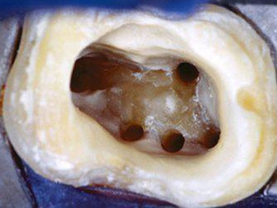 5 каналов в зубе. Без микроскопа их нахождение было бы затруднено