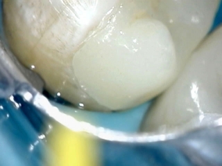 Контроль прилегания реставрации к зубу
