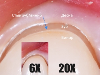 Линия стыка между реставрацией и биологическим зубом