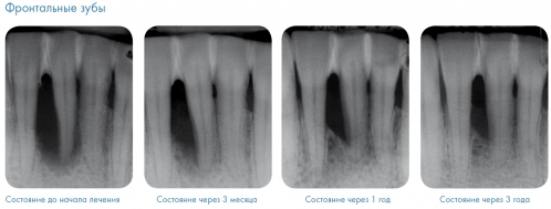 Эффект от применения основной и поддерживающей терапии Vector на фронтальных зубах
