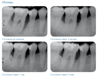 Эффект от применения основной и поддерживающей терапии Vector на жевательных зубах