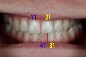 Асимметрия зубных рядов