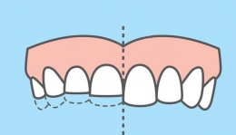 Повышенная стираемость зубов