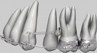 Работа ортодонтического микроимплантата