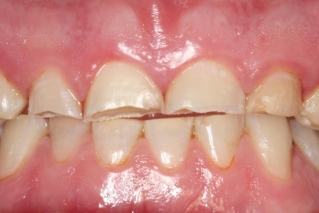 Ультраниры не помогут при повышенной стираемости зубов