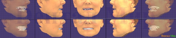 Применение DSD с учетом восстановления функции зубов