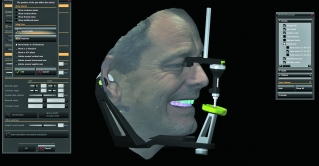 3D изображение лица пациента в артикуляторе с проектируемыми зубами
