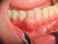 Фотография полости рта. Опухоль в пародонтальных тканях