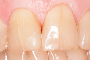 Трещина на фронтальном зубе
