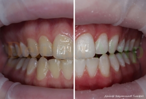 Отбеливание зубов Zoom. До и после процедуры