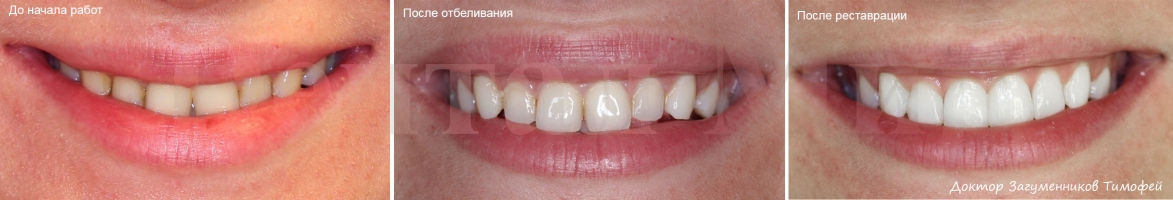 Отбеливание зубов Amazing White с последующей эстетической реставрацией фронтальных зубов