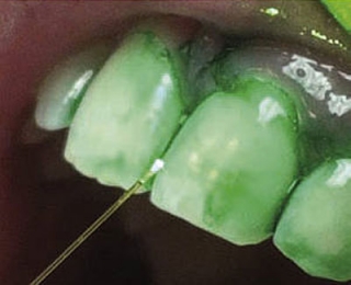 Нанесенный на зубы фотосенсибилизатор