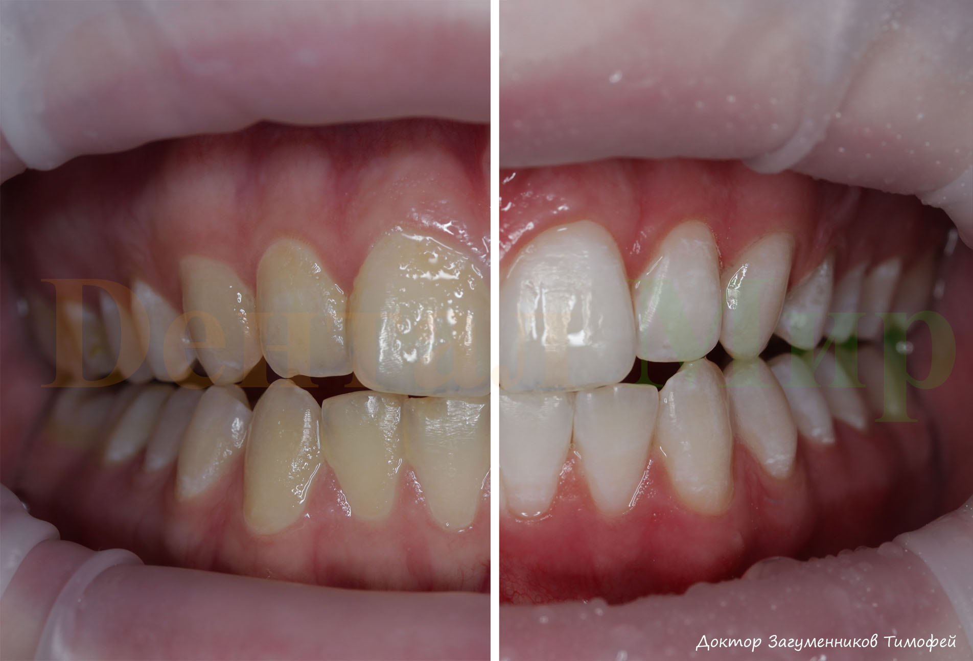 Зубы после отбеливания фото