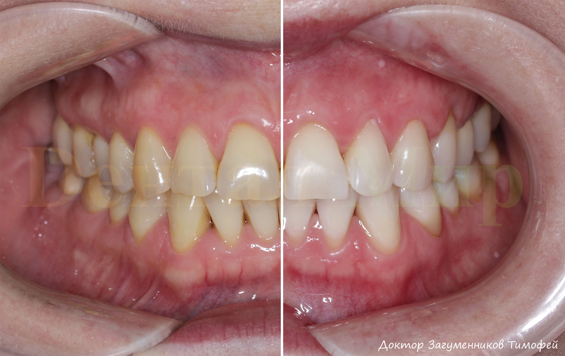 Отбеливание Amazing White для чувствительных зубов. Фото, отзывы, цены |  Стоматология Дентал Мир