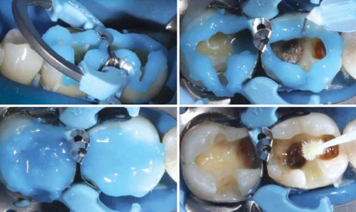 Протравка полости в зубе перед постановкой пломбы