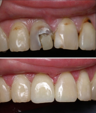 Восстановление формы и цвета переднего зуба