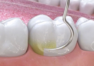 Гигиеническая чистка полости рта перед художественной реставрацией необходима для корректного определения цвета зубов