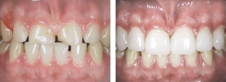 В результате реставрации изменены форма зубов, цвет выбран светлее на несколько тонов