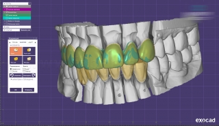 Итоговое детальное эстетическое моделирование выполняется техником высокой квалификации в зуботехнической лаборатории