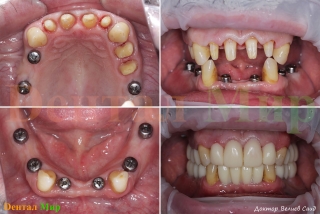 Зубы подготовлены под протезирование