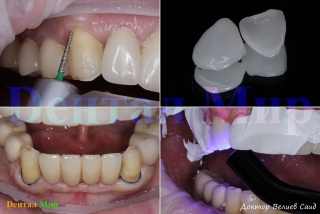 Препарирование зубов под виниры и их установка