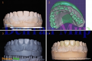 Гипсовая модель, DSD, планируемый внешний вид зубов, распечатанный на 3D принтере, WaxUp