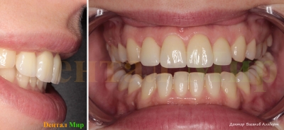 Результат первого этапа - четыре винира в полости рта. Фронтальный и боковой снимок