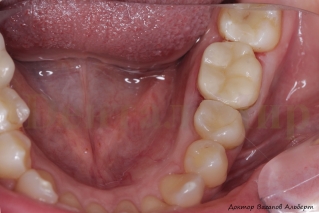 Накладка On-lay Cerec на зубе окклюзионное фото