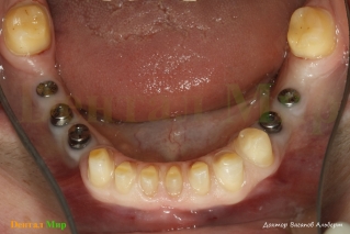Препарирование зубов нижней челюсти