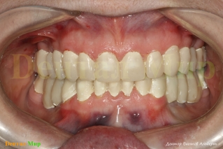 Планирование MockUp в полости рта. Так будут выглядеть зубы
