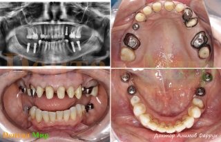 Этапы лечения. После имплантации, зубы подготовлены под протезирование