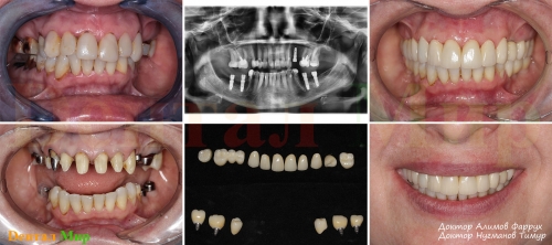 Обзор лечения. Имплантация зубов и протезирование. Установлено 5 имплантатов и 18 керамических коронок
