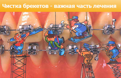 Чистка брекетов и зубов