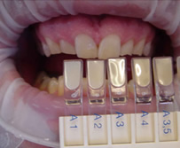 Определение цвета зубов