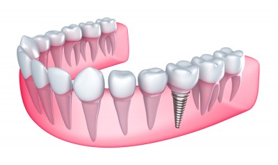 Имплантат зуба, искусственный корень