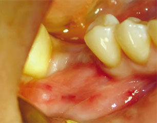 Имплантация зубов, первый хирургический этап 