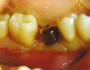 Имплантация зубов, второй хирургический этап 