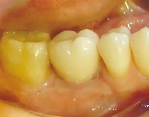 Имплантация зубов, ортопедический этап 