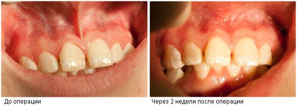 Результат операции пластики уздечки губы
