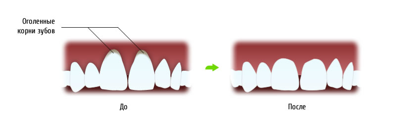 Оголение корней зубов