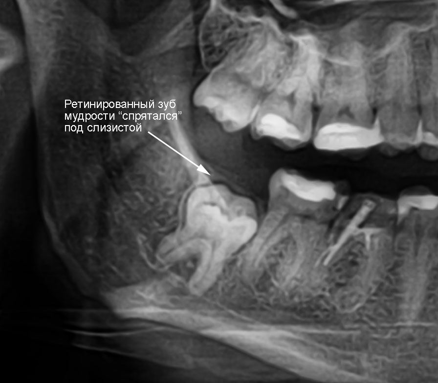 Ретинированный зуб, рентген.