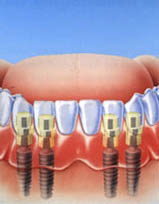 Отсутствие одного зуба – прямое показание к имплантации