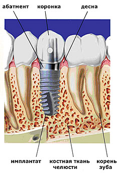 Зубной имплант - схема