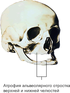 Атрофия альвеолярного отростка челюсти приводит к ее истончению. Возникает повышенный риск перелома.