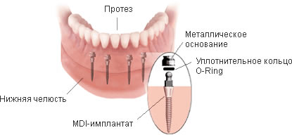 MDI-имплантат