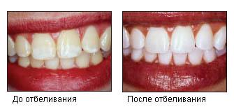 Отбеливание зубов Opalescence Томск Мостовой Реставрация молочных зубов Томск Заветный
