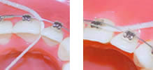 Очистка зубных промежутков с помощью зубной нити