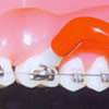 Чистка задних зубов вокруг бректов с помощью специальной однопучковой щетки.