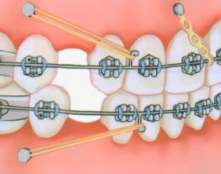 Ортодонтические имплантаты